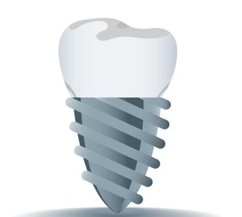 השתלת שיניים